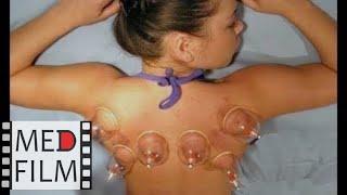 Как правильно ставить банки © Cupping therapy